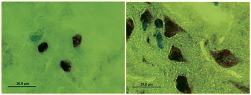 FUS/TLS gene